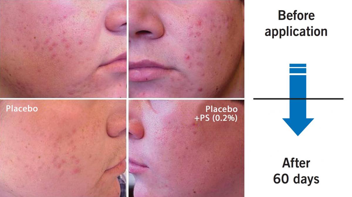 Phytosphingosine against Acne Before/After