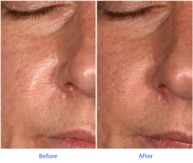 Evermat Sederma Before After